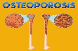 osteoporosis2.jpg
